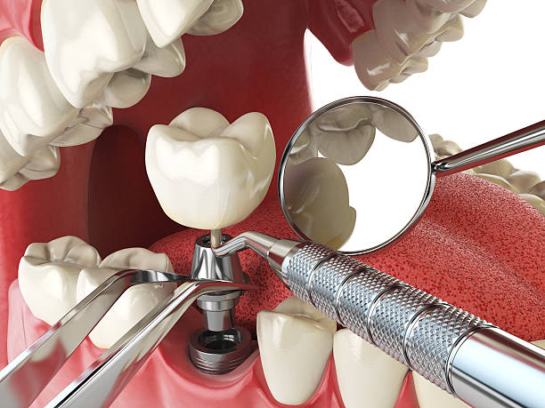 Best Root Canal Emergency Dentist  in Kittredge, CO